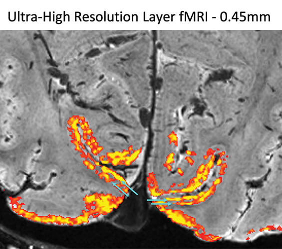 Figure 4. This NexGen 7T fMRI scan