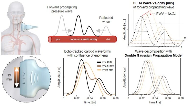 Advancing the local Pulse Wave Velocity Measurement – Wave Confluence Decomposition using a Double Gaussian Propagation Model