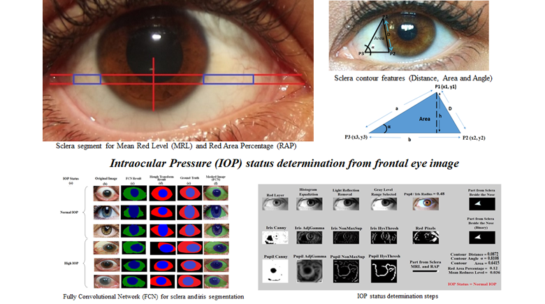 Automated Vision Based High Intraocular Pressure Detection Using 